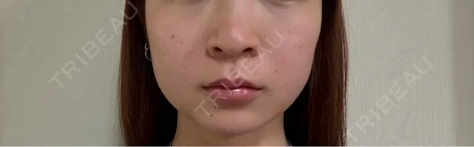 糸リフト / 脂肪吸引（顔） / 脂肪吸引注射（顔） ziz CLINIC DAY 12 メイン用