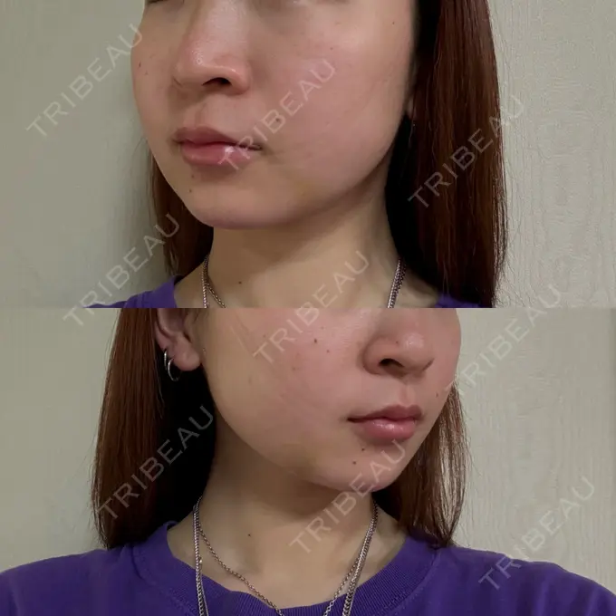 糸リフト / 脂肪吸引（顔） / 脂肪吸引注射（顔） ziz CLINIC DAY 12 メイン用