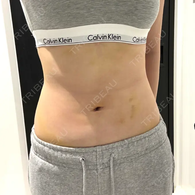 脂肪吸引（お腹） / 医療痩身（お腹） 4Dクリニック DAY 8 メイン用