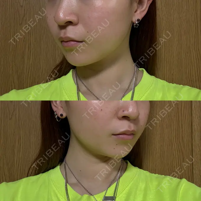 糸リフト / 脂肪吸引（顔） / 脂肪吸引注射（顔） ziz CLINIC DAY 21 メイン用