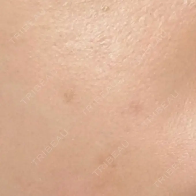 ほくろ・いぼ除去レーザー（肌） みやた形成外科・皮ふクリニック DAY 47 メイン用