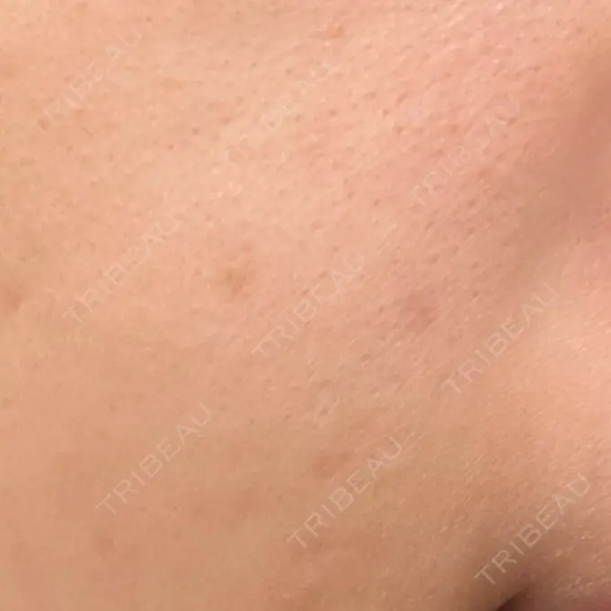 ほくろ・いぼ除去レーザー（肌） みやた形成外科・皮ふクリニック DAY 57 メイン用