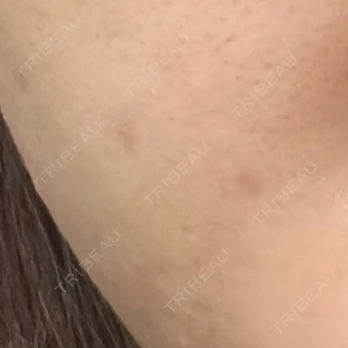 ほくろ・いぼ除去レーザー（肌） みやた形成外科・皮ふクリニック DAY 30 メイン用