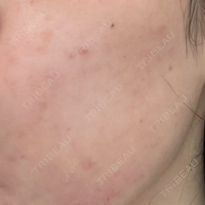 エレクトロポレーション SK新宿歌舞伎町美容外科・歯科 DAY 0 メイン用