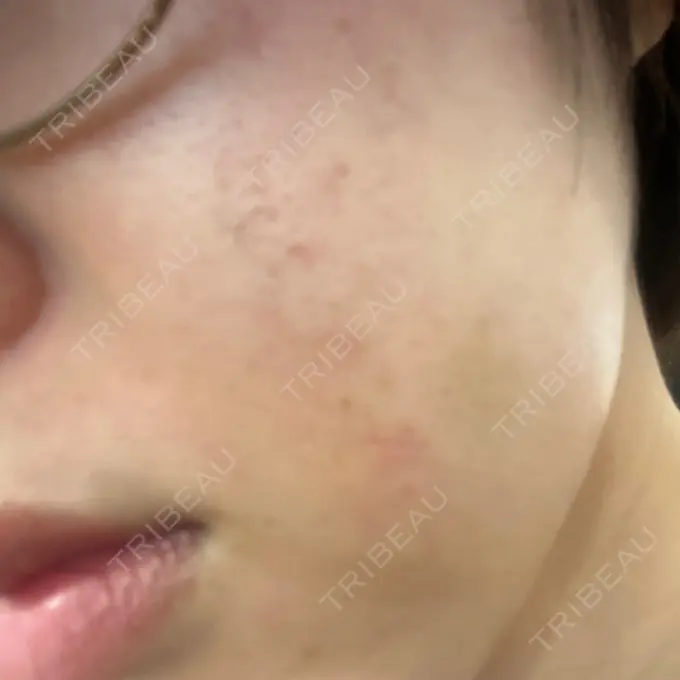 医療脱毛（顔） 共立美容外科 立川院 DAY 0 メイン用