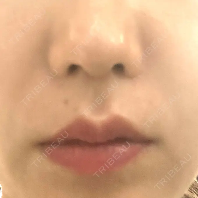 ハイフ（顔） クレオビューティークリニック DAY 2 メイン用