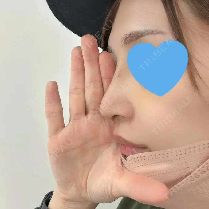 軟骨移植 / 眉間プロテーゼ / 鼻尖縮小 / ヒアルロン酸注入（鼻翼基部） 東京シンデレラ美容外科 新宿院 DAY 7 メイン用