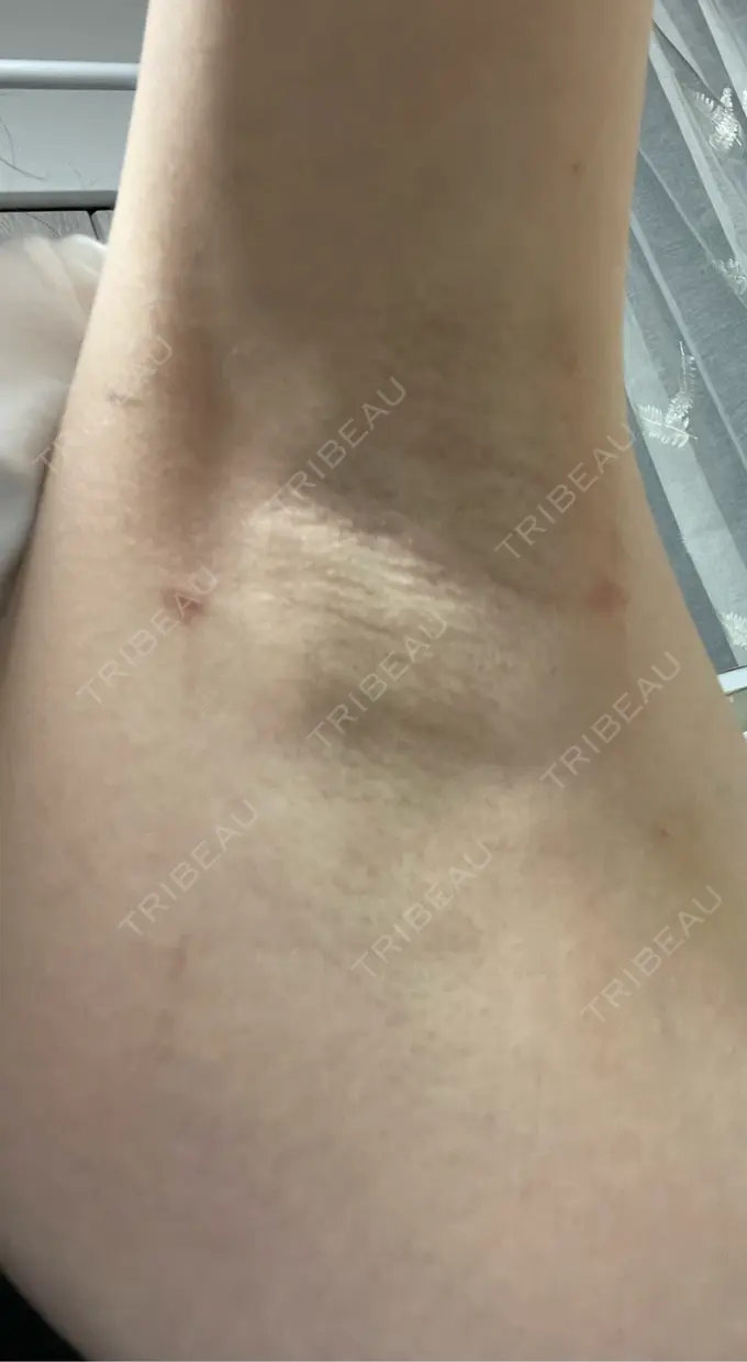 ワキ汗治療（レーザー） ルラ美容クリニック 渋谷本院 DAY 3 メイン用