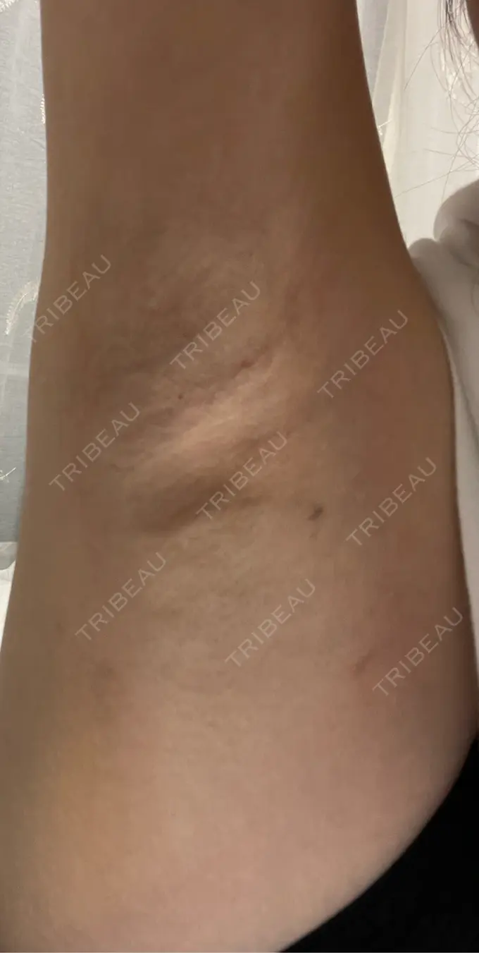 ワキ汗治療（レーザー） ルラ美容クリニック 渋谷本院 DAY 3 メイン用