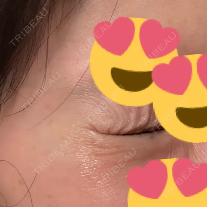 ボトックス（あご） / シワ取りボトックス / ボトックス（眉間） / ボトックス（目尻） 大阪TAクリニック DAY 5 メイン用