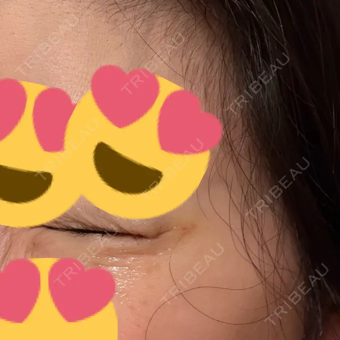 ボトックス（あご） / シワ取りボトックス / ボトックス（眉間） / ボトックス（目尻） 大阪TAクリニック DAY 5 メイン用