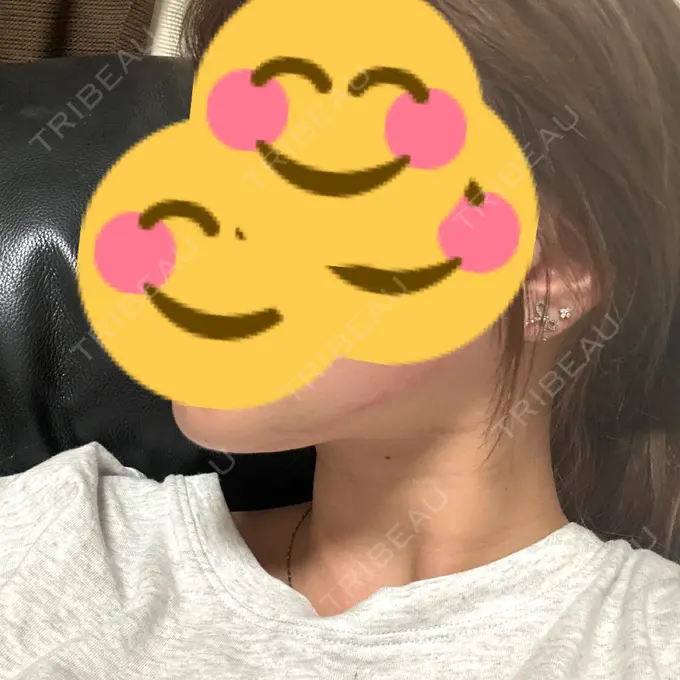 その他（肌） / RF（高周波）たるみ治療 ゆきスキンクリニック 東池袋 DAY 0 メイン用