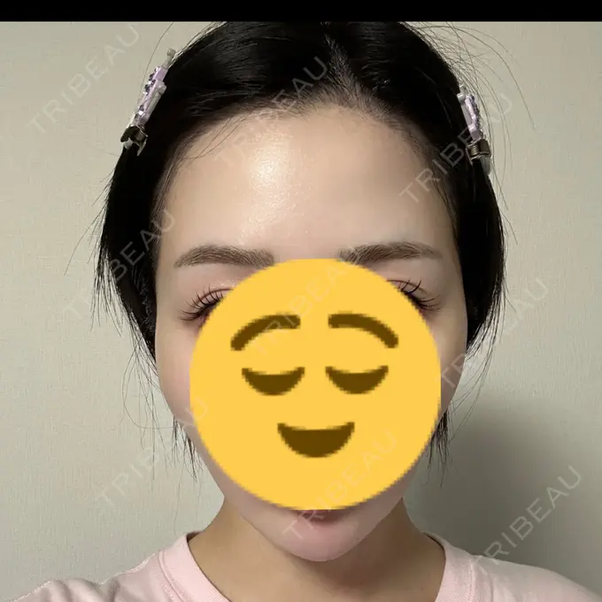 ハイフ（顔） ミニマムスキンクリニック池袋 AFTER メイン用