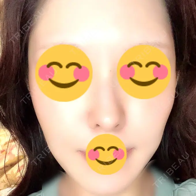 ヒアルロン酸注入（頬） / ヒアルロン酸注入（こめかみ） / ヒアルロン酸注入（鼻翼基部） ziz CLINIC AFTER メイン用