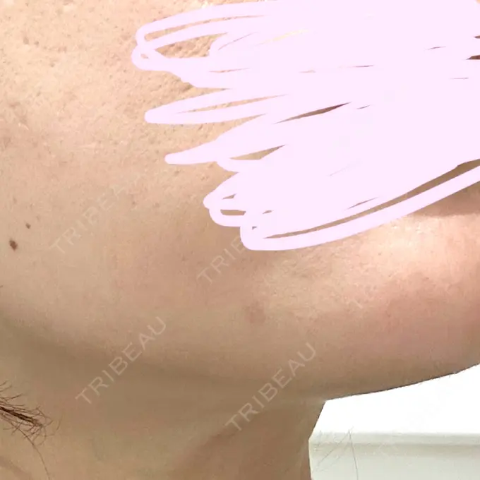 ルメッカ REDLINE CLINIC AFTER メイン用