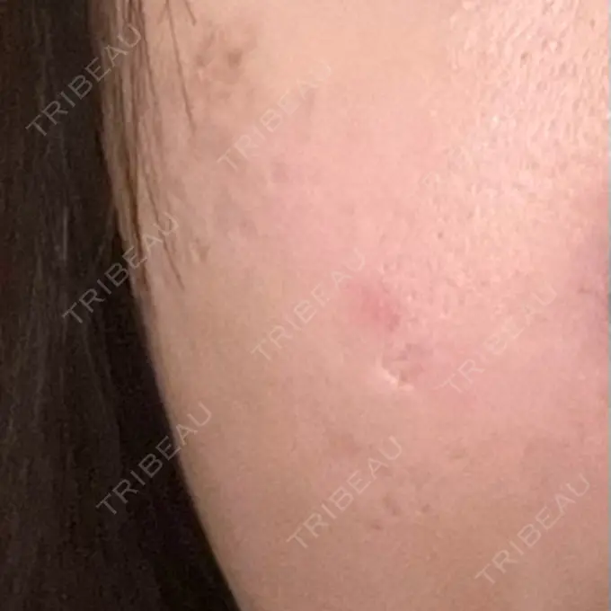 ルメッカ REDLINE CLINIC DAY 11 メイン用