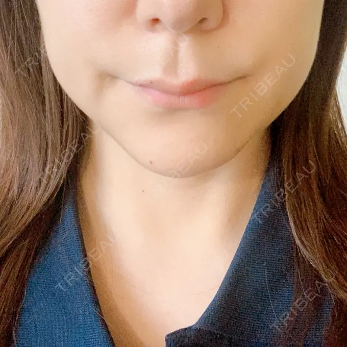 ボトックス（エラ・小顔） / マイクロボトックス / ボトックス（首） / ボトックス（人中） 筋肉・美容クリニック DAY 4 メイン用