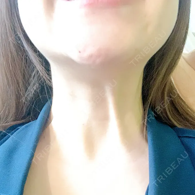 ボトックス（エラ・小顔） / マイクロボトックス / ボトックス（首） / ボトックス（人中） 筋肉・美容クリニック DAY 4 メイン用