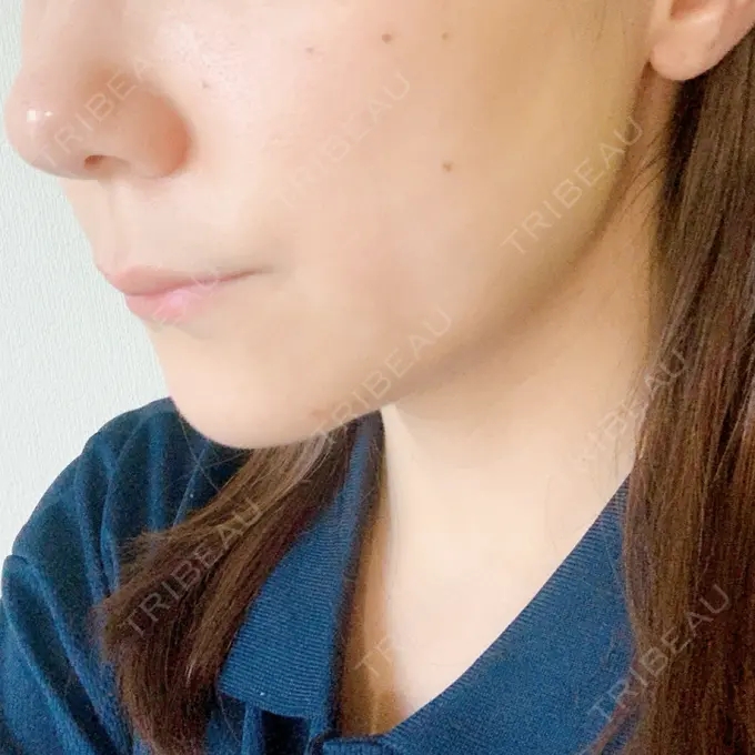 ボトックス（エラ・小顔） / マイクロボトックス / ボトックス（首） / ボトックス（人中） 筋肉・美容クリニック DAY 4 メイン用