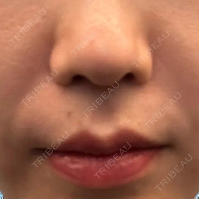 ハイフ（顔） クレオビューティークリニック DAY 3 メイン用