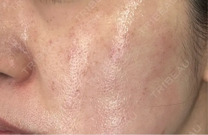 フラクショナルレーザー（毛穴・ニキビ跡） Designo Clinic （デジーノクリニック） DAY 0 メイン用