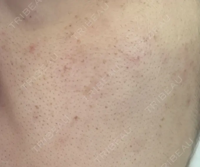 フラクショナルレーザー（毛穴・ニキビ跡） Designo Clinic （デジーノクリニック） DAY 1 メイン用