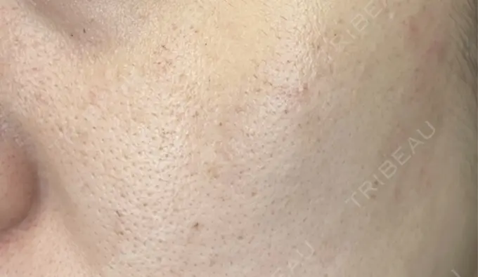 フラクショナルレーザー（毛穴・ニキビ跡） Designo Clinic （デジーノクリニック） DAY 2 メイン用