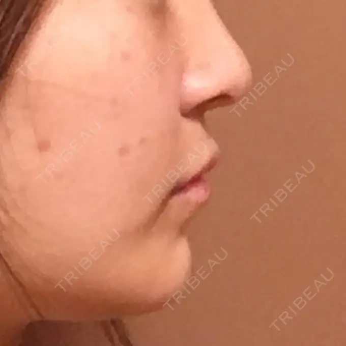 バッカルファット除去 / 脂肪吸引（顔） / セットバック 銀座フェイスクリニック（小顔整形・輪郭整形專門） AFTER メイン用