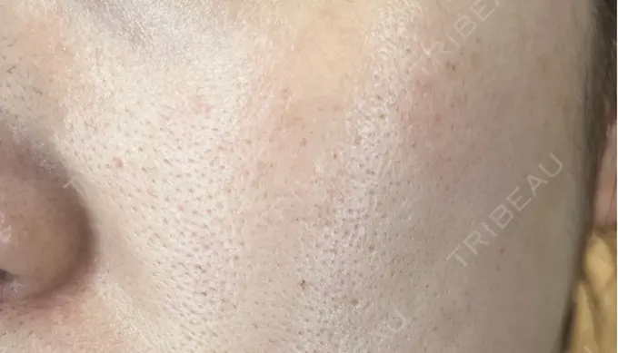 フラクショナルレーザー（毛穴・ニキビ跡） Designo Clinic （デジーノクリニック） DAY 5 メイン用