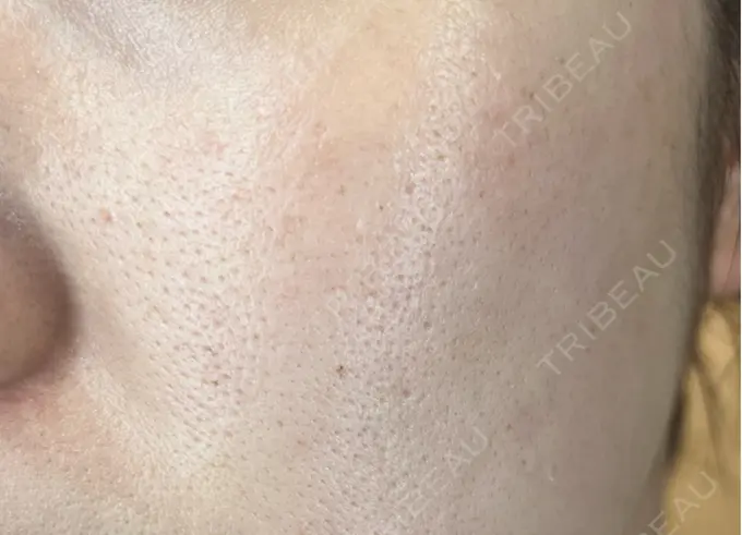 フラクショナルレーザー（毛穴・ニキビ跡） Designo Clinic （デジーノクリニック） DAY 5 メイン用