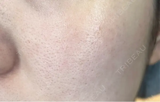 フラクショナルレーザー（毛穴・ニキビ跡） Designo Clinic （デジーノクリニック） AFTER メイン用