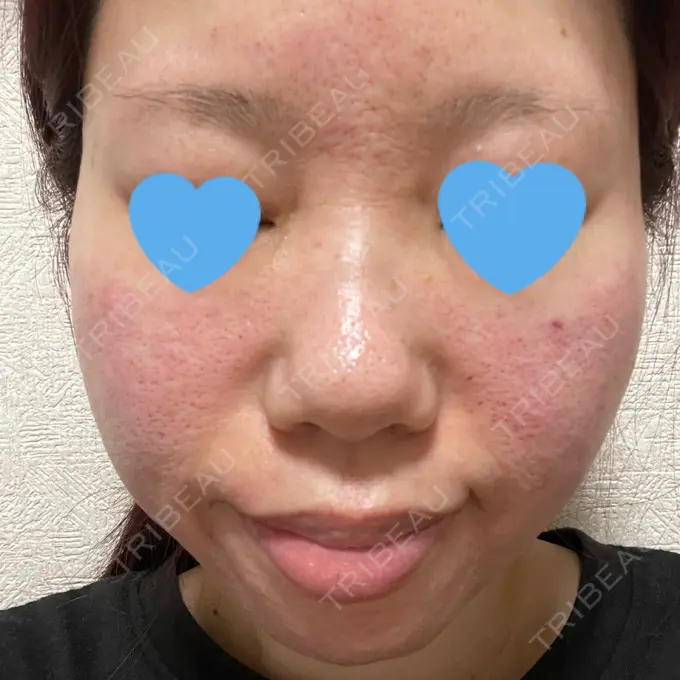 マイクロボトックス / 肌育注射（ジュベルックなど） ミニマムスキンクリニック池袋 DAY 0 メイン用