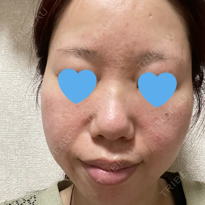 マイクロボトックス / 肌育注射（ジュベルックなど） ミニマムスキンクリニック池袋 DAY 2 メイン用