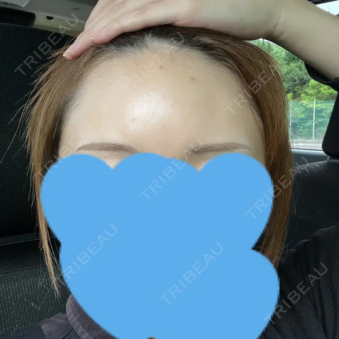 ヒアルロン酸注入（額） アモーレクリニック 名古屋院 DAY 1 メイン用