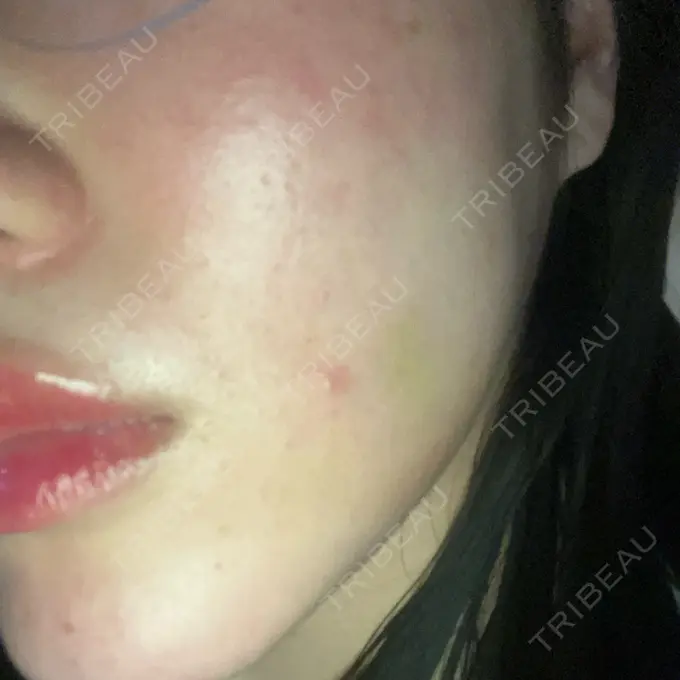 医療脱毛（顔） 共立美容外科 立川院 DAY 1 メイン用