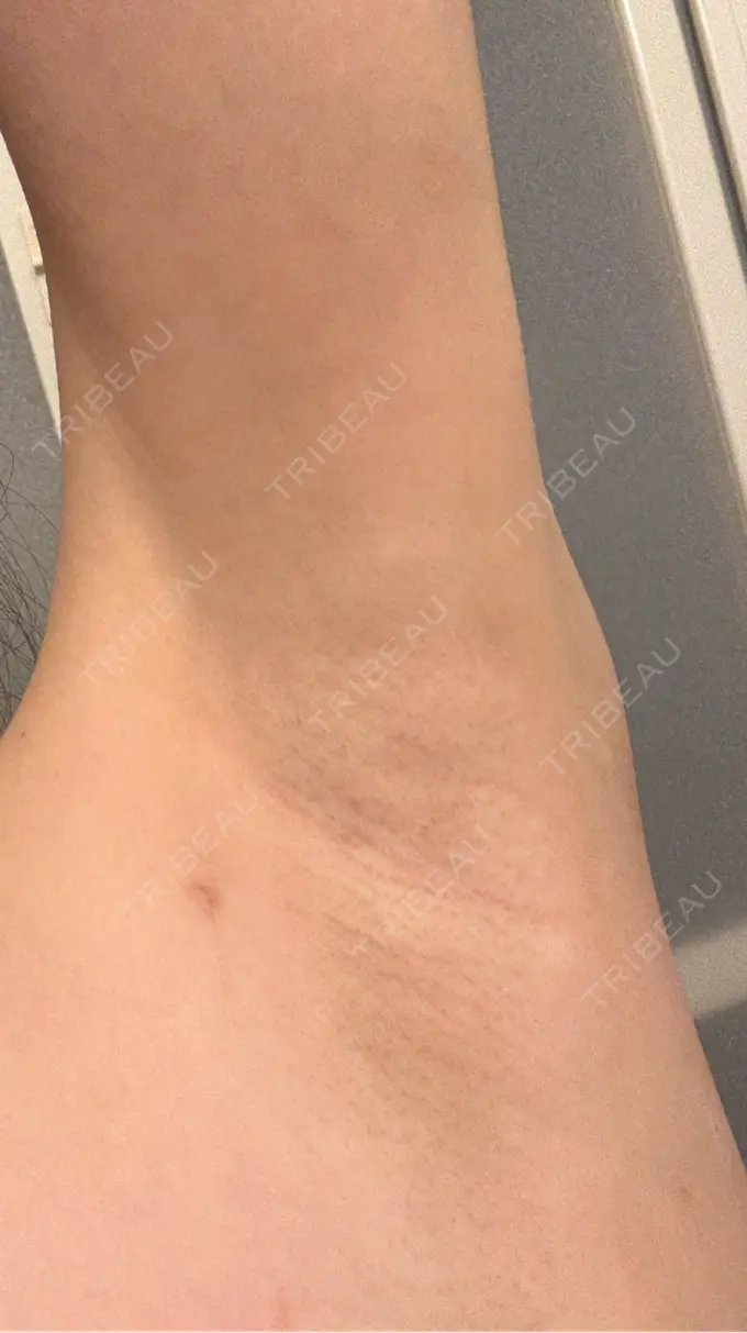 ワキ汗治療（レーザー） ルラ美容クリニック 渋谷本院 DAY 5 メイン用