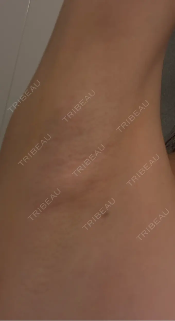 ワキ汗治療（レーザー） ルラ美容クリニック 渋谷本院 DAY 5 メイン用