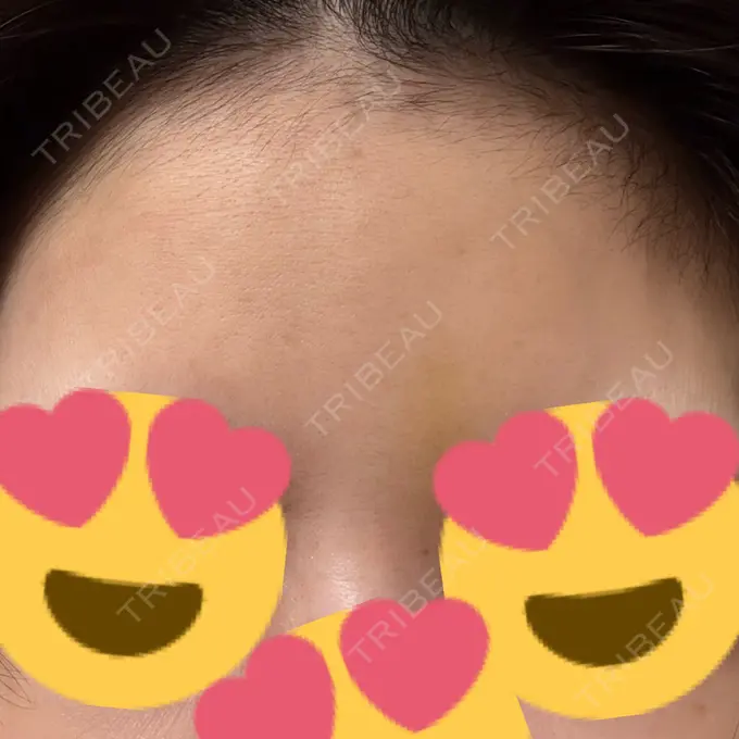 ボトックス（あご） / シワ取りボトックス / ボトックス（眉間） / ボトックス（目尻） 大阪TAクリニック AFTER メイン用