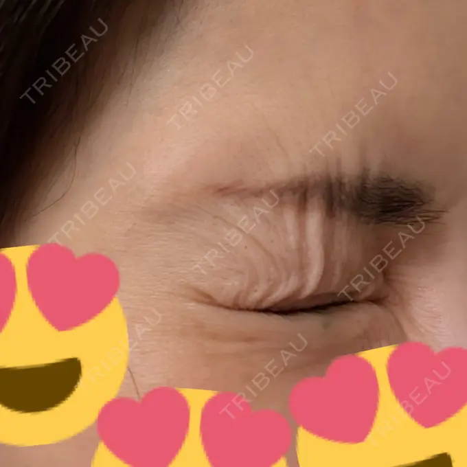 ボトックス（あご） / シワ取りボトックス / ボトックス（眉間） / ボトックス（目尻） 大阪TAクリニック DAY 7 メイン用