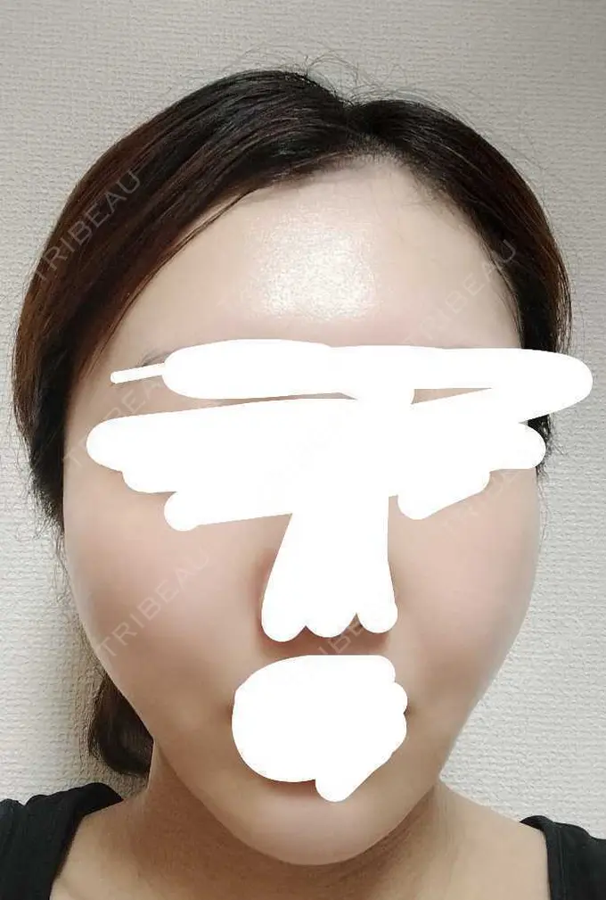 糸リフト アリエル美容クリニック 横浜院 DAY 3 メイン用