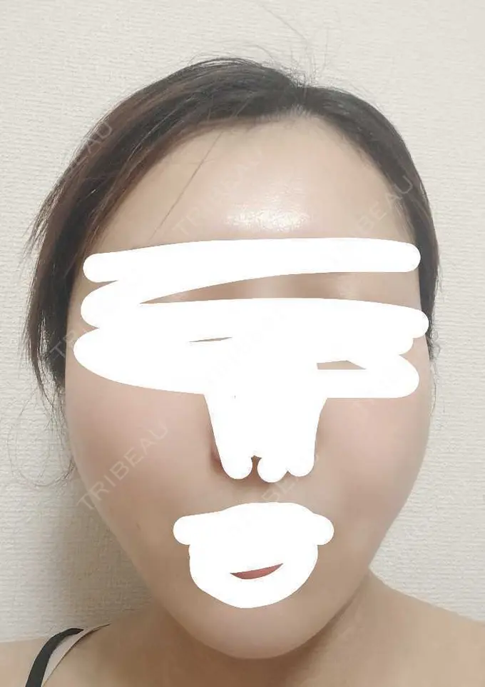 糸リフト アリエル美容クリニック 横浜院 DAY 4 メイン用