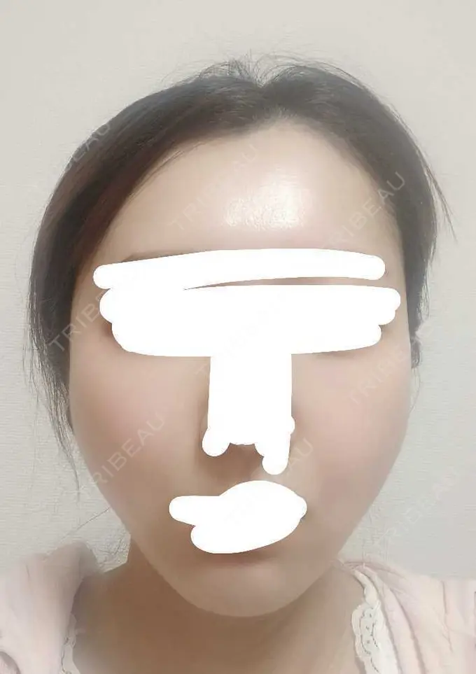 糸リフト アリエル美容クリニック 横浜院 DAY 5 メイン用