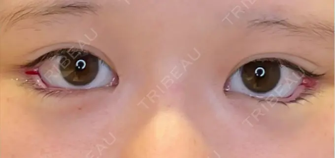 目尻切開 / タレ目形成・グラマラスライン（埋没） LOUIS CLINIC 二子玉川院【ルイクリニック】 DAY 0 メイン用