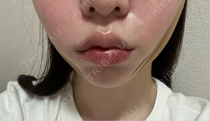 糸リフト / バッカルファット除去 / ヒアルロン酸注入（あご） 大阪TAクリニック DAY 0 メイン用