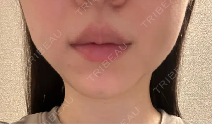 糸リフト / バッカルファット除去 / ヒアルロン酸注入（あご） 大阪TAクリニック DAY 2 メイン用