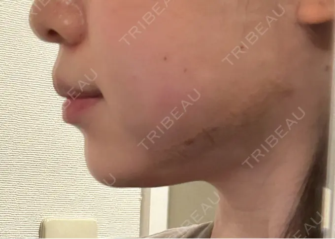 糸リフト / バッカルファット除去 / ヒアルロン酸注入（あご） 大阪TAクリニック DAY 2 メイン用