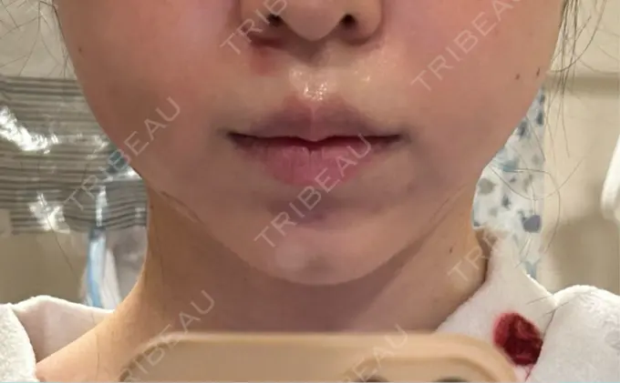 糸リフト / バッカルファット除去 / ヒアルロン酸注入（あご） 大阪TAクリニック DAY 3 メイン用