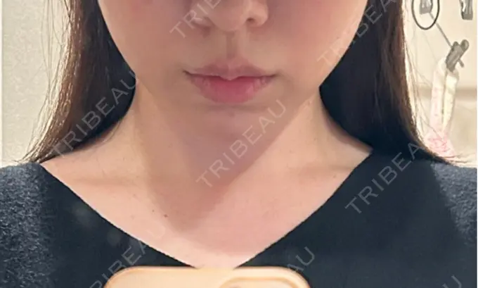 糸リフト / バッカルファット除去 / ヒアルロン酸注入（あご） 大阪TAクリニック DAY 9 メイン用