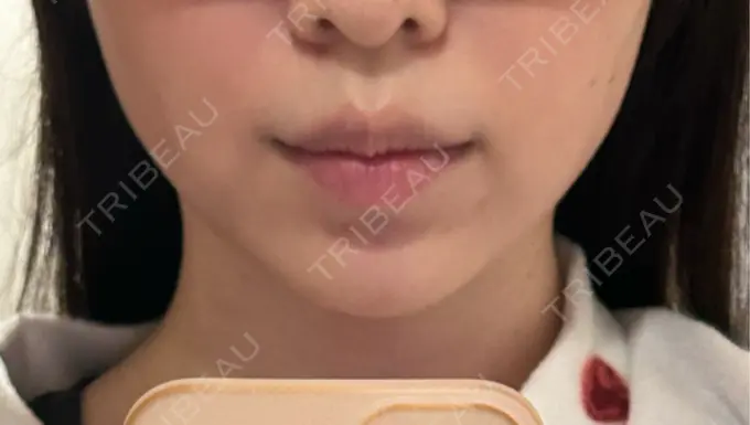 糸リフト / バッカルファット除去 / ヒアルロン酸注入（あご） 大阪TAクリニック AFTER メイン用