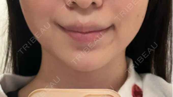 糸リフト / バッカルファット除去 / ヒアルロン酸注入（あご） 大阪TAクリニック DAY 13 メイン用